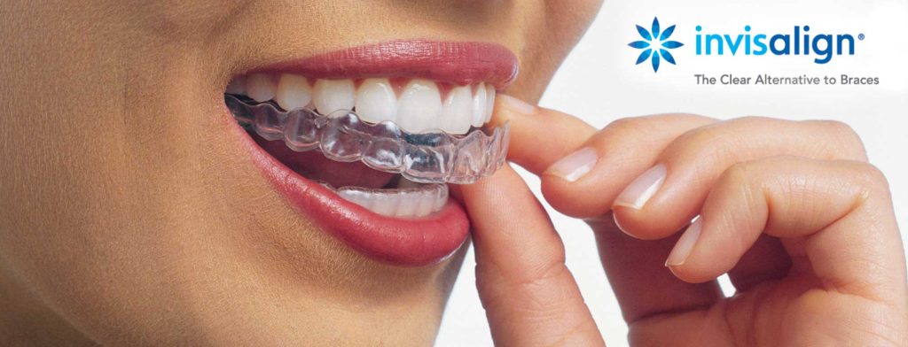 invisalign vs clear braces