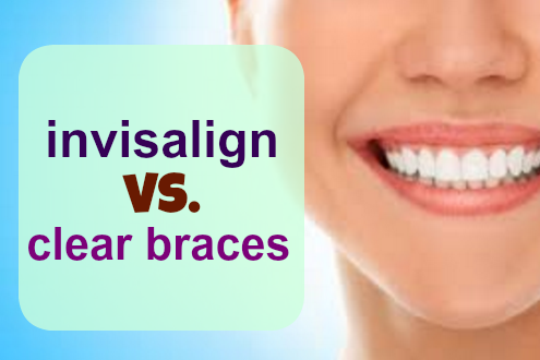 Invisalign vs. Clear Braces