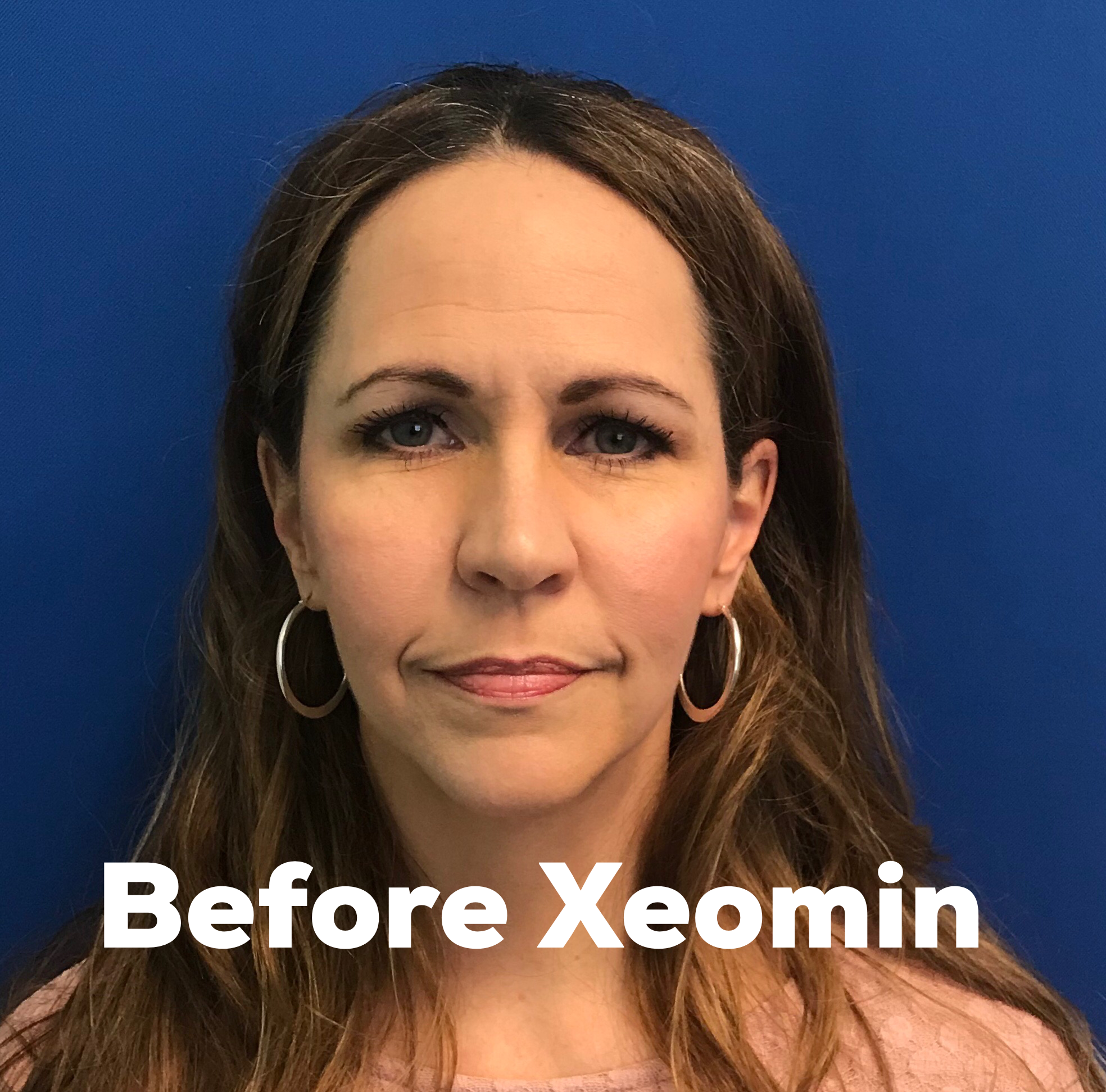 Xeomin before after pictures